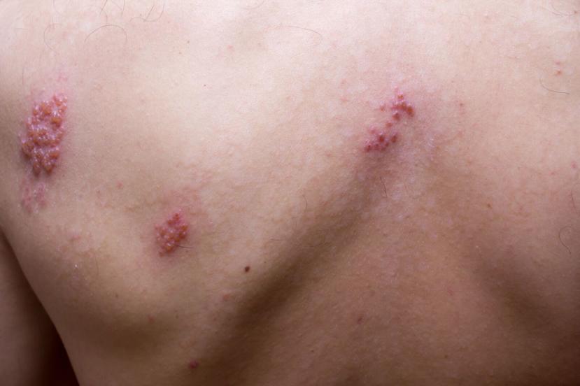 What are the Signs and Symptoms of Rosacea?