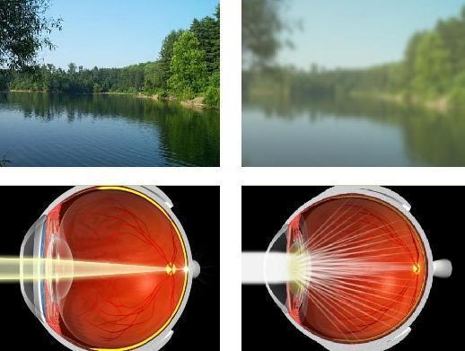 Cataracts