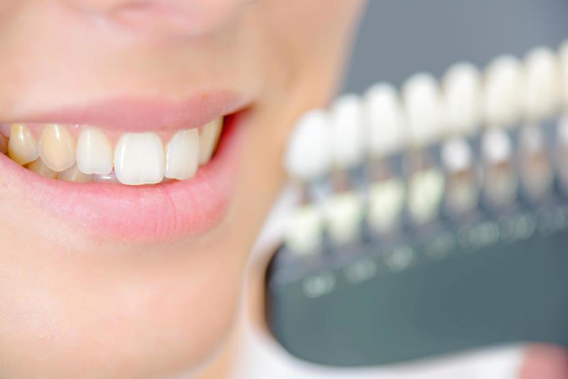 Veneers for Irreversibly Stained Teeth