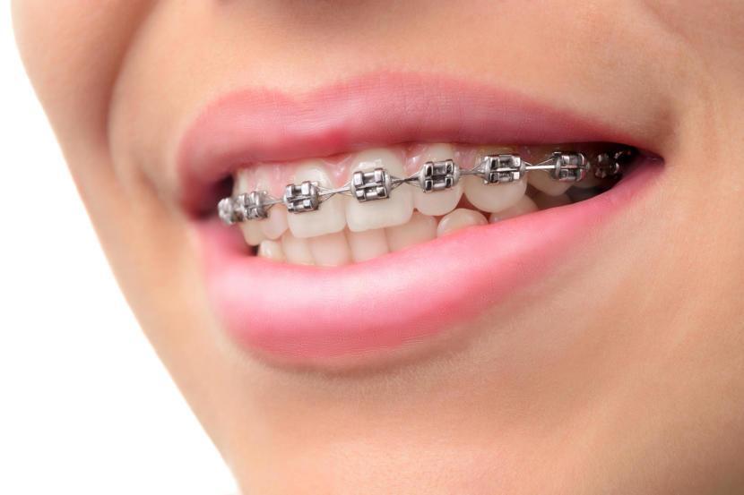 Why Aren’t the Gaps in My Teeth Closing?
