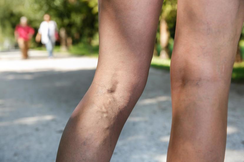 Flaunt Your legs – Get Rid of Varicose Veins