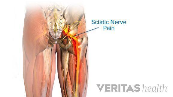 Sciatica Treatment Options