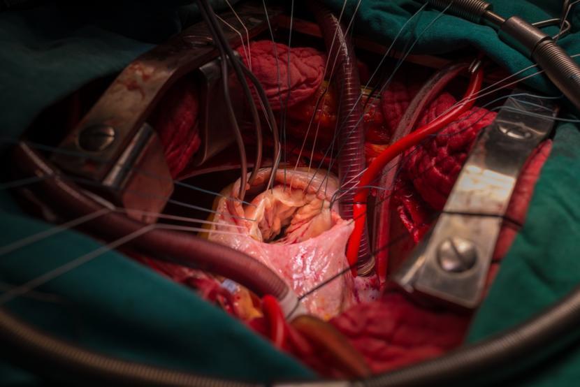 Does an Enlarged Heart Affect Health?