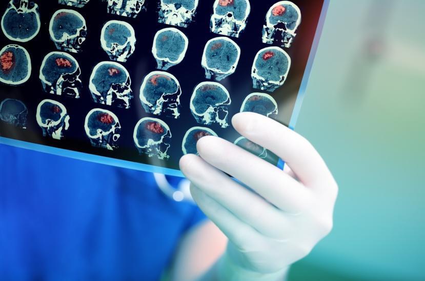 Brain Tumor: Types, Causes, Symptoms, Diagnosis and Treatment