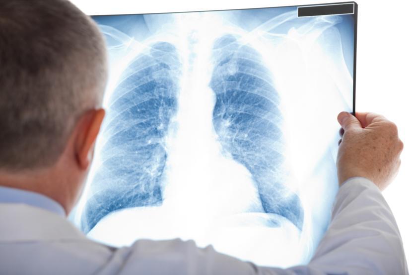 Everything You Need to Know About Bronchitis