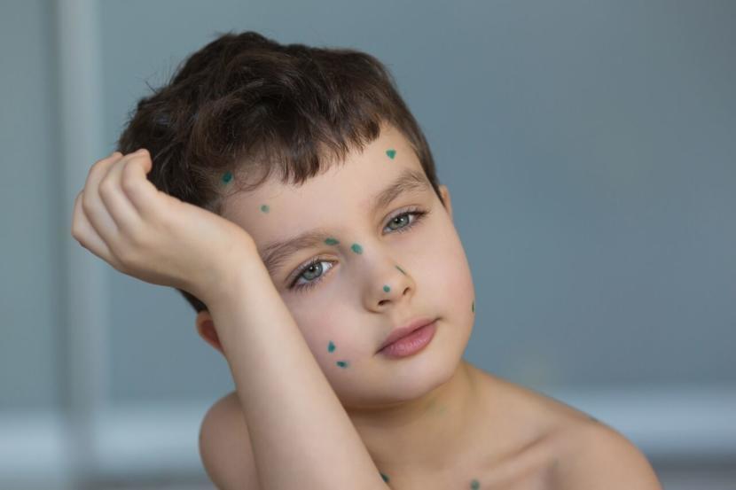 How is Chicken Pox Diagnosed?