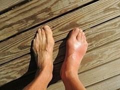How Is Gout Diagnosed?