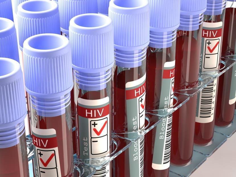 How is HIV Diagnosed?