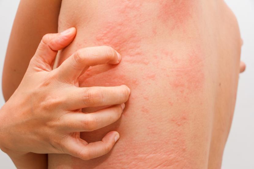 Is Scabies a Sexually Transmitted Disease (STD)?