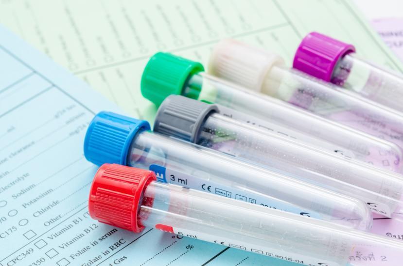 Promising Results for Hodgkin Patients Using This Therapy