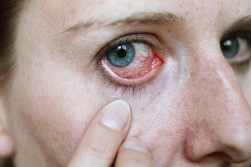 What are the Symptoms of Allergies?