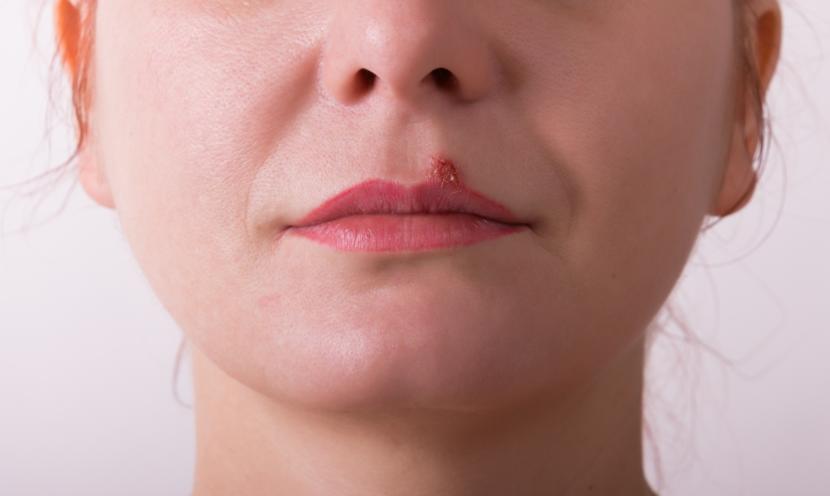 What Are the Symptoms of Cold Sores?