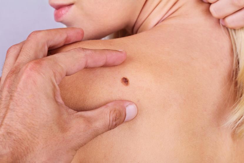What are the Symptoms of Melanoma?
