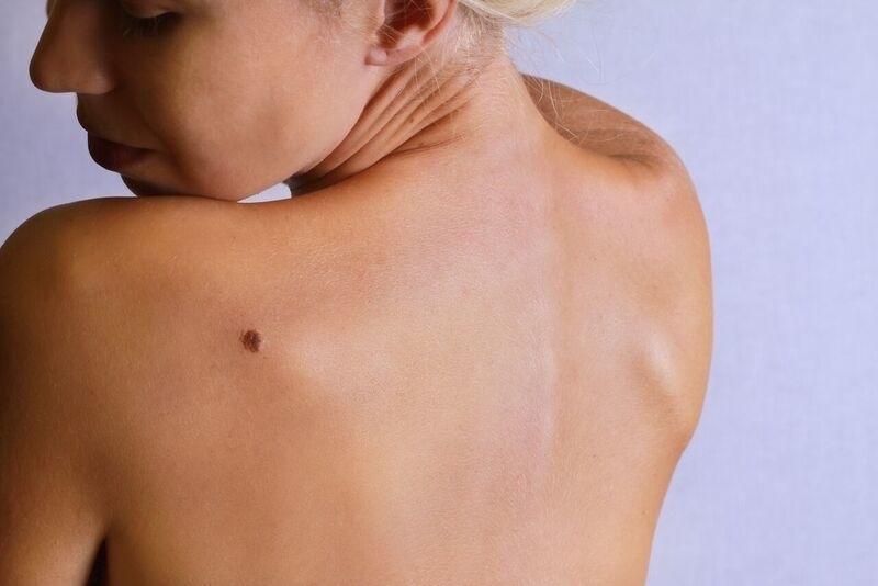 What Does Melanoma Look Like?