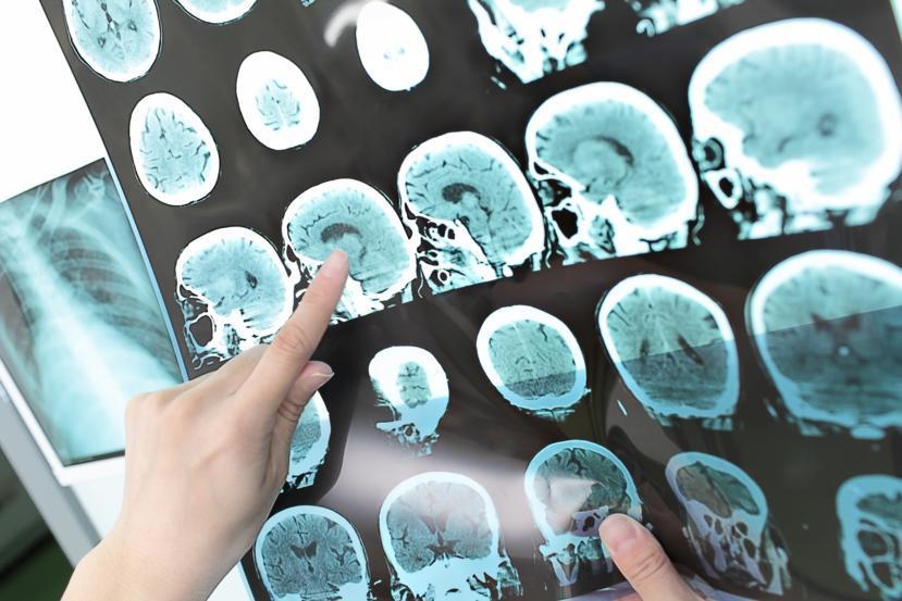 What is a Transient Ischemic Attack?