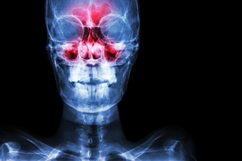 What is Sinusitis? Get the Facts