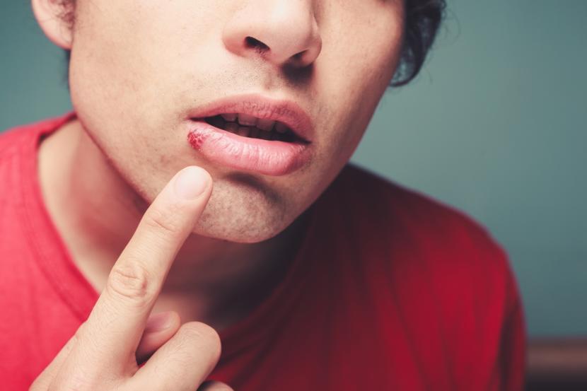 Where Does Genital Herpes Appear on My Body if I Have It?