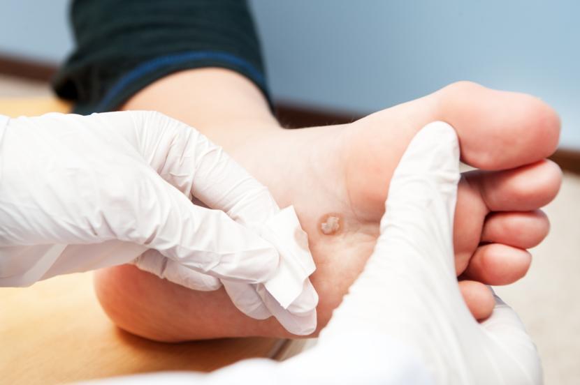Warts