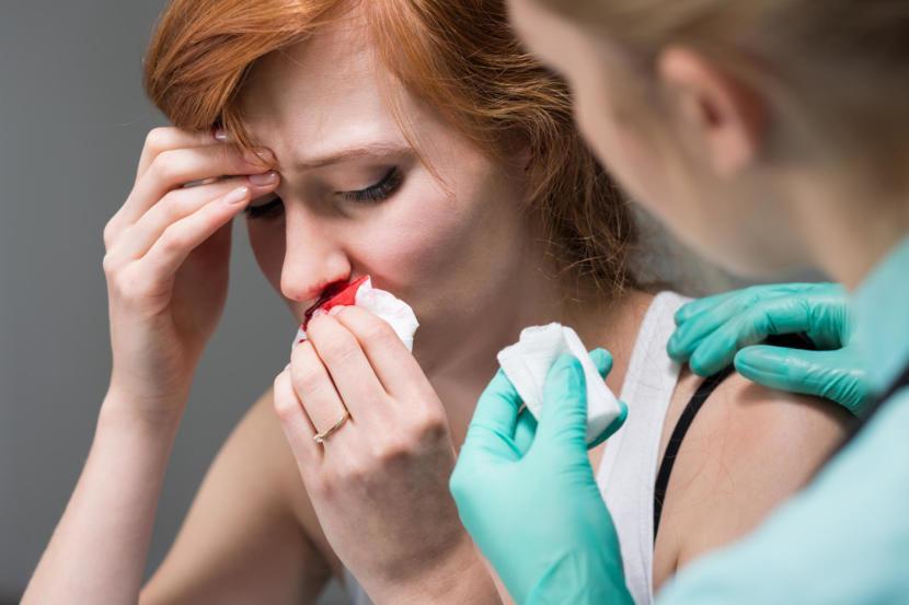 What Is Epistaxis?