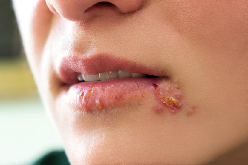 Herpes simplex virus type 1 (HSV-1)