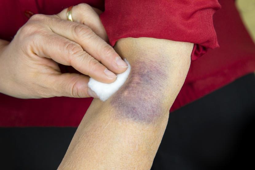 Bruise: Types, Symptoms & Causes