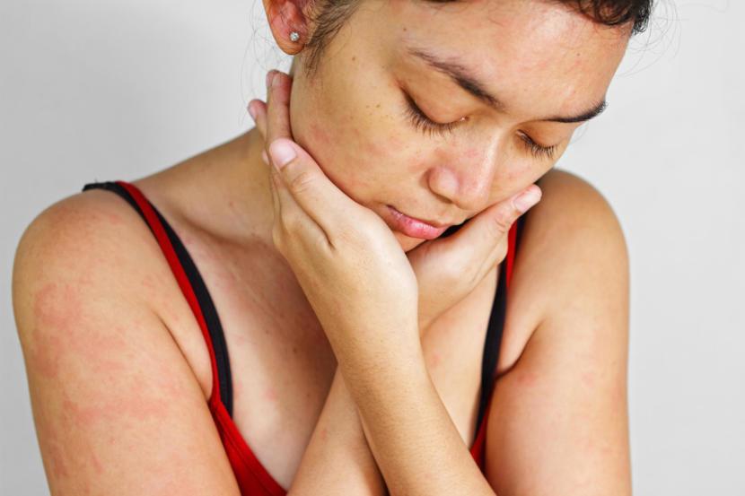 What Is Molluscum Contagiosum