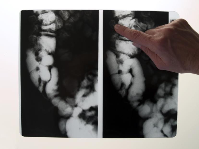 Use Breast Shields to Reduce Radiation Damage During CT Scans