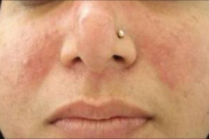 Facerash